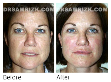 Female face, before and after Facelift and necklift treatment, front view, patient 15