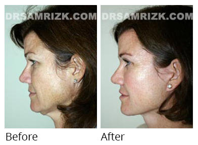 Female face, before and after Facelift and necklift treatment, side view, patient 15