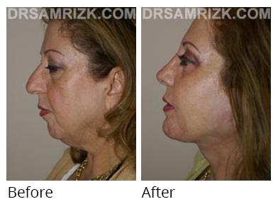 Female face, before and after Facelift and necklift treatment, side view, patient 16