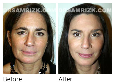 Female face, before and after Facelift and necklift treatment, front view, patient 17