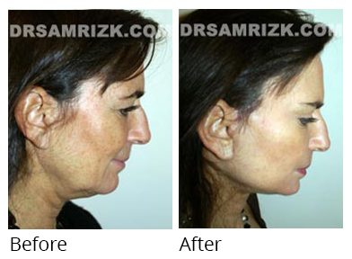 Female face, before and after Facelift and necklift treatment, side view, patient 17