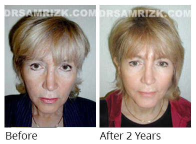 Female face, before and after Facelift and necklift treatment, front view, patient 18