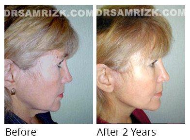 Female face, before and after Facelift and necklift treatment, side view, patient 18