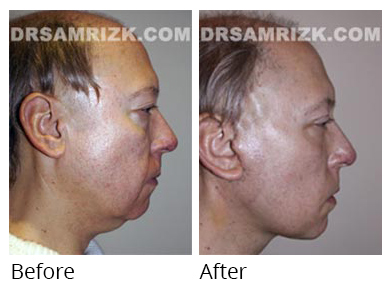 Male face, before and after Facelift and necklift treatment, side view, patient 19