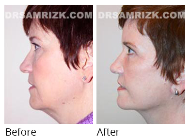 Female face, before and after Facelift and necklift treatment, side view, patient 20