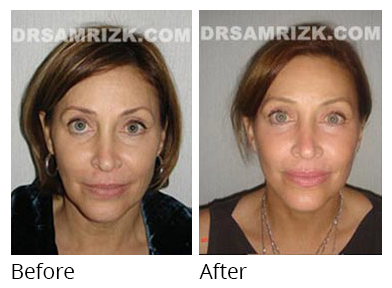 Female face, before and after Facelift and necklift treatment, front view, patient 21