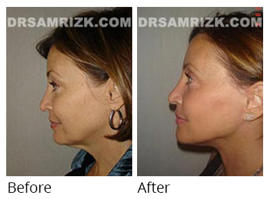 Female face, before and after Facelift and necklift treatment, side view, patient 21