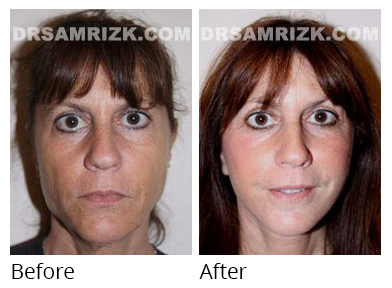 Female face, before and after Facelift and necklift treatment, front view, patient 22