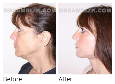 Female face, before and after Facelift and necklift treatment, side view, patient 22