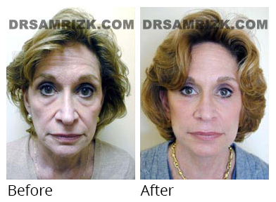 Female face, before and after Facelift and necklift treatment, front view, patient 23