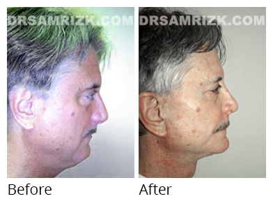 Male face, before and after Facelift and necklift treatment, side view, patient 24
