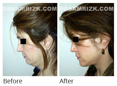 Female face, before and after Facelift and necklift treatment, l-side view, patient 25
