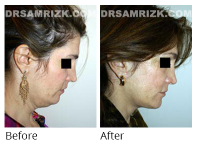 Female face, before and after Facelift and necklift treatment, r-side view, patient 25