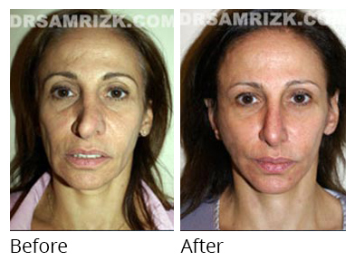 Female face, before and after Facelift and necklift treatment, front view, patient 26