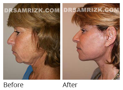 Female face, before and after Facelift and necklift treatment, side view, patient 9