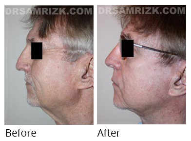 Male face, before and after Facelift and necklift treatment, side view, patient 27