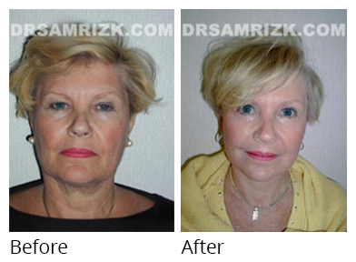 Female face, before and after Facelift and necklift treatment, front view, patient 28