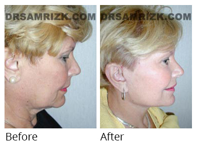Female face, before and after Facelift and necklift treatment, r-side view, patient 28