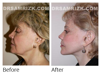 Female face, before and after Facelift and necklift treatment, l-side view, patient 29