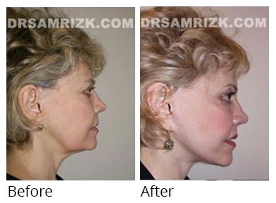 Female face, before and after Facelift and necklift treatment, r-side view, patient 29