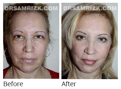 Female face, before and after Facelift and necklift treatment, front view, patient 31