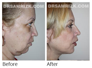Female face, before and after Facelift and necklift treatment, r-side view, patient 31