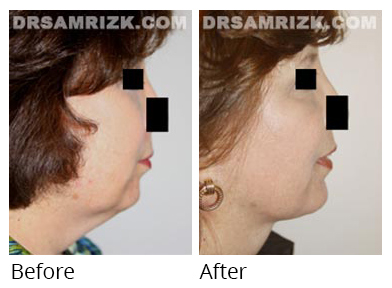 Female face, before and after Facelift and necklift treatment, r-side view, patient 32