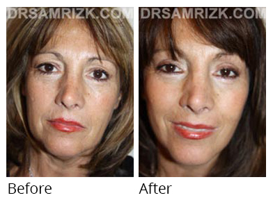 Female face, before and after Facelift and necklift treatment, front view, patient 33