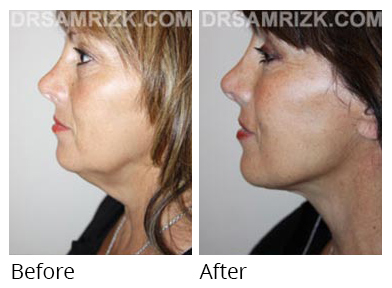 Female face, before and after Facelift and necklift treatment, l-side view, patient 33