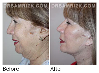 Female face, before and after Facelift and necklift treatment, l-side view, patient 34