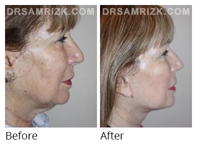 Female face, before and after Facelift and necklift treatment, r-side view, patient 34