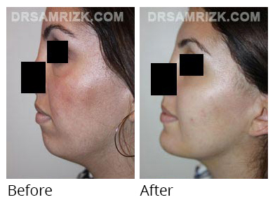 Female face, before and after Facelift and necklift treatment, l-side view, patient 36