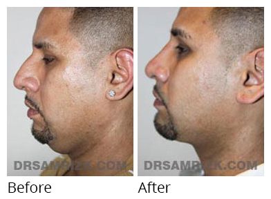 Male face, before and after Facelift and necklift treatment, l-side view, patient 37