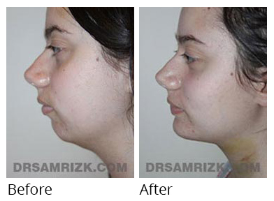 Female face, before and after Facelift and necklift treatment, l-side view, patient 38