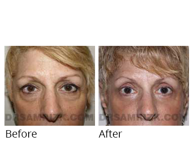 Female face, before and after Facelift and necklift treatment, front view, patient 40