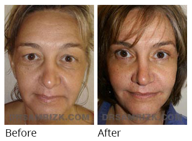 Female face, before and after Facelift and necklift treatment, front view, patient 41