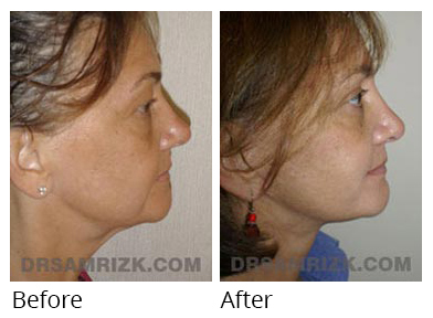 Female face, before and after Facelift and necklift treatment, l-side view, patient 41