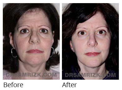 Female face, before and after Facelift and necklift treatment, front view, patient 7