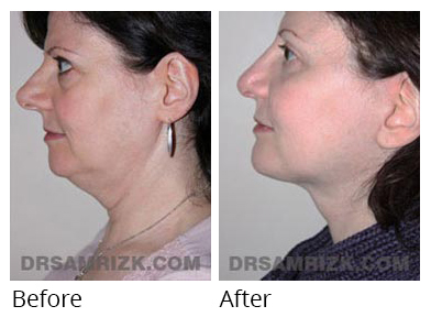 Female face, before and after Facelift and necklift treatment, side view, patient 7