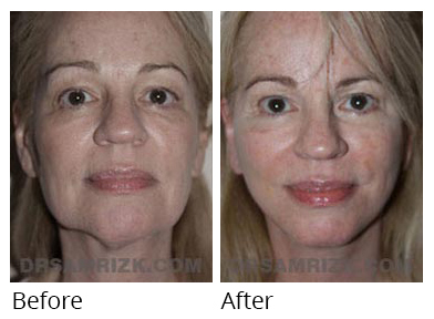 Female face, before and after Facelift and necklift treatment, front view, patient 42
