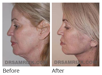 Female face, before and after Facelift and necklift treatment, l-side view, patient 42