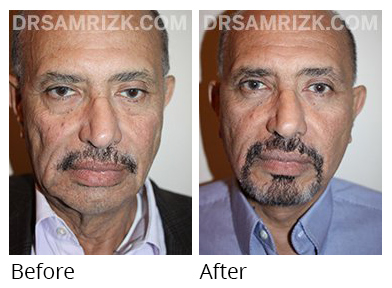 Male face, before and after Facelift and necklift treatment, front view, patient 8