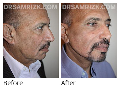 Male face, before and after Facelift and necklift treatment, oblique view, patient 8