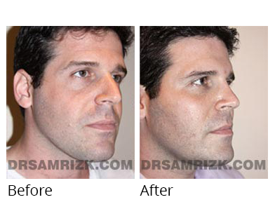 Male face, before and after Facelift and necklift treatment, oblique view, patient 43