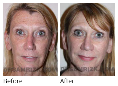 Female face, before and after Facelift and necklift treatment, front view, patient 44
