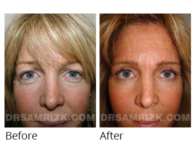 Female face, before and after Facelift and necklift treatment, front view, patient 45