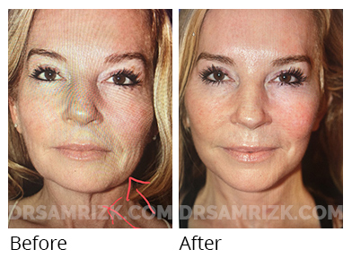 Female face, before and after Facelift and necklift treatment, front view, patient 46