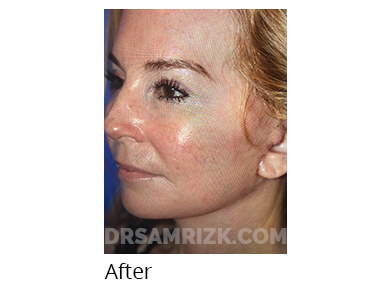 Female face, after Facelift and necklift treatment, oblique view, patient 46