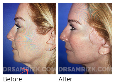 Female face, before and after Facelift and necklift treatment, l-side view, patient 46