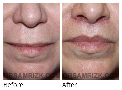 Lip Lift patient before and after photo